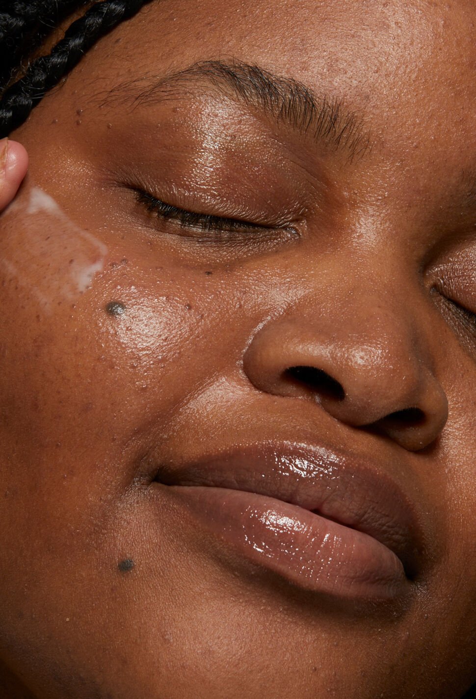 Skin Purging